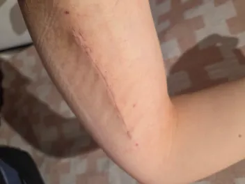 Arm after the sutures were removed after median nerve surgery