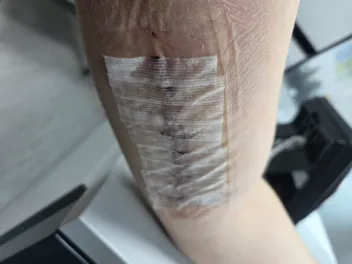 Arm before the sutures were removed after median nerve surgery